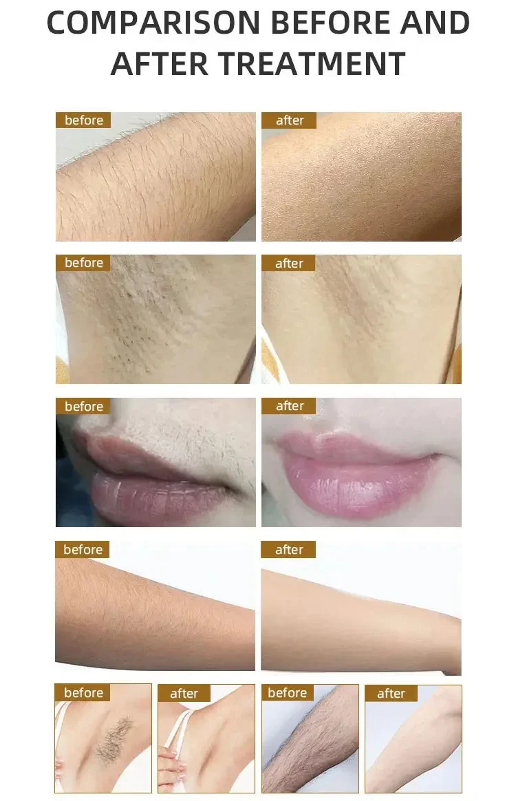 2024 professional Alexandrite Laser 2500W 755nm 808nm 1064nm Diode Laser Epilation Portable Laser Hair Removal machine - Image 6