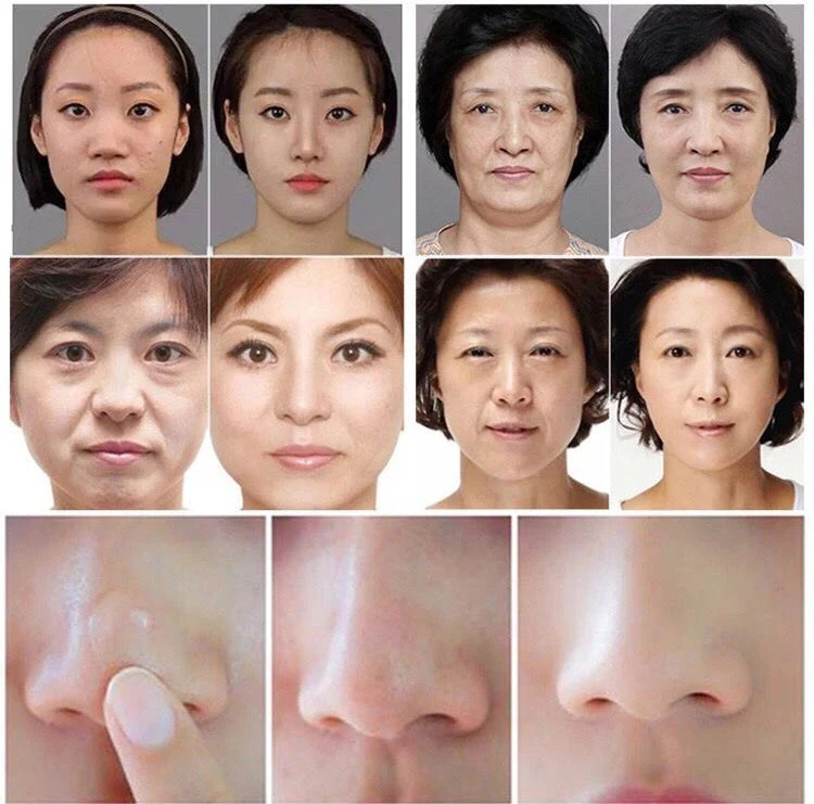 3 In 1 Deep Face Cleansing Aquasure H2 Device H2o2 Water Oxygen Peeling Dermabrasion Cleaning Machine - Image 11