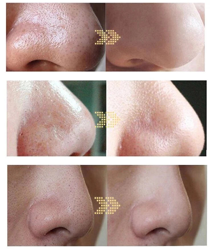 3 In 1 Deep Face Cleansing Aquasure H2 Device H2o2 Water Oxygen Peeling Dermabrasion Cleaning Machine - Image 7