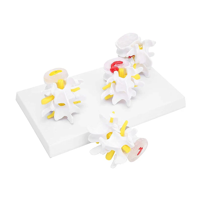 4-stage Pathological Human Lumbar Spine Anatomy Model Medical Science Teaching Resources - Image 2