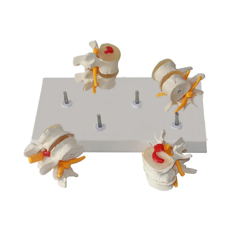 4-stage Pathological Human Lumbar Spine Anatomy Model Medical Science Teaching Resources - Image 3