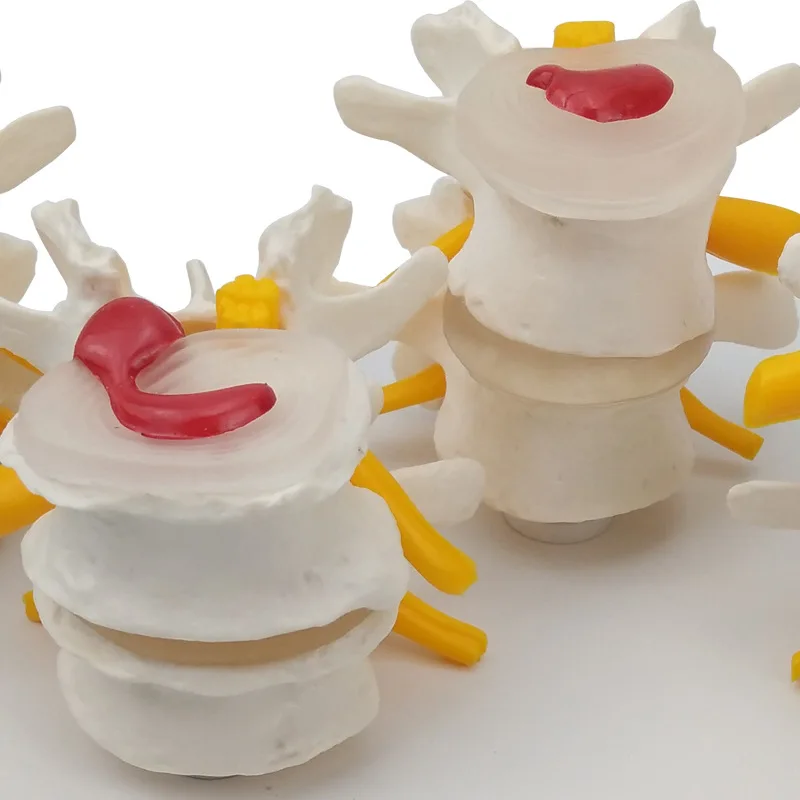 4-stage Pathological Human Lumbar Spine Anatomy Model Medical Science Teaching Resources - Image 4