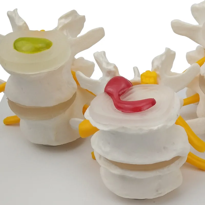 4-stage Pathological Human Lumbar Spine Anatomy Model Medical Science Teaching Resources - Image 5