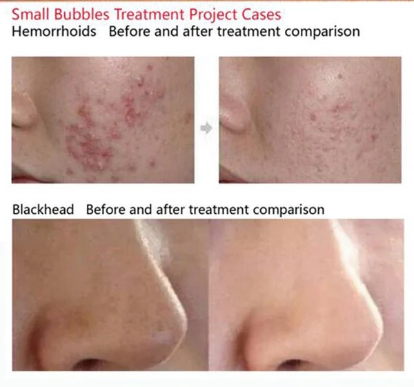 6 In 1 Vacuum face cleaning Hydro Dermabrasion Water Oxygen Jet Peel Machine for Vacuum Pore Cleaner Facial Massage Machine - Image 15