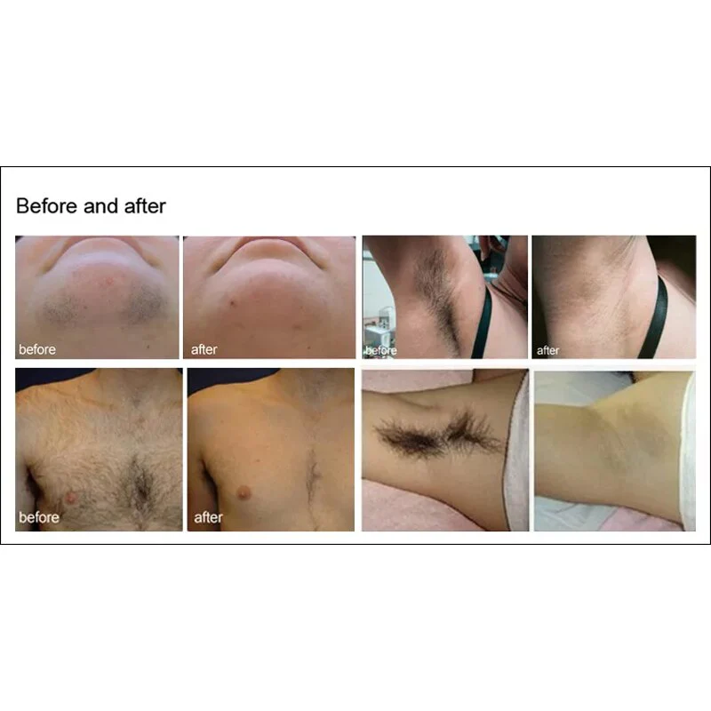808nm Laser Hair Removal Machine Diode Laser Hair Removal Laser Professional 2023 Professional Hair Removal Salon - Image 6