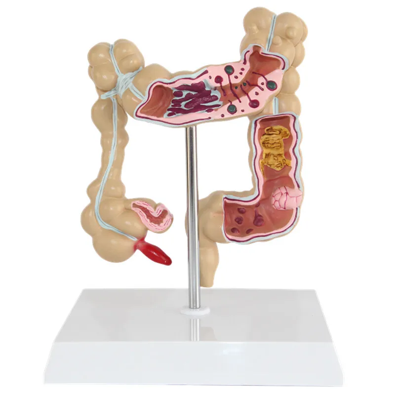 Anatomical Human Colorectal Lesion Model Anatomy Colon Diseases Intestine Medical Teaching Learning Supplies Tool - Image 2