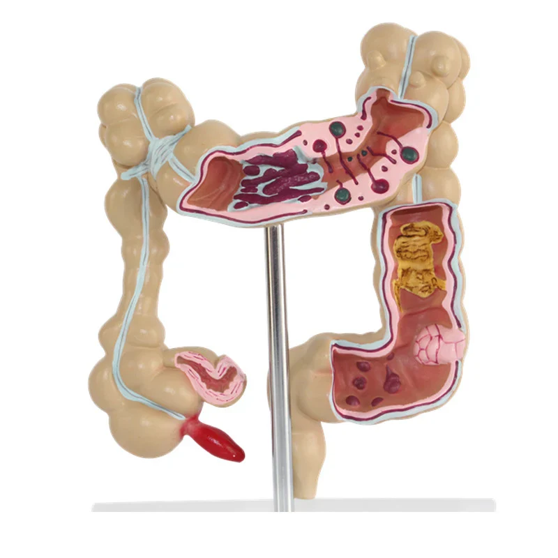 Anatomical Human Colorectal Lesion Model Anatomy Colon Diseases Intestine Medical Teaching Learning Supplies Tool - Image 3