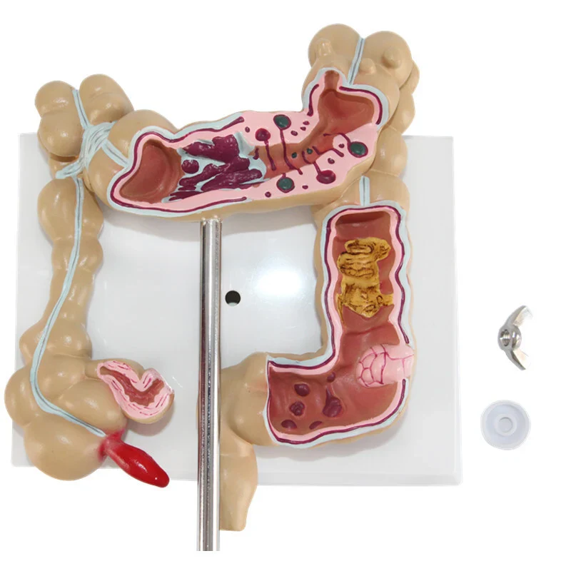 Anatomical Human Colorectal Lesion Model Anatomy Colon Diseases Intestine Medical Teaching Learning Supplies Tool - Image 4