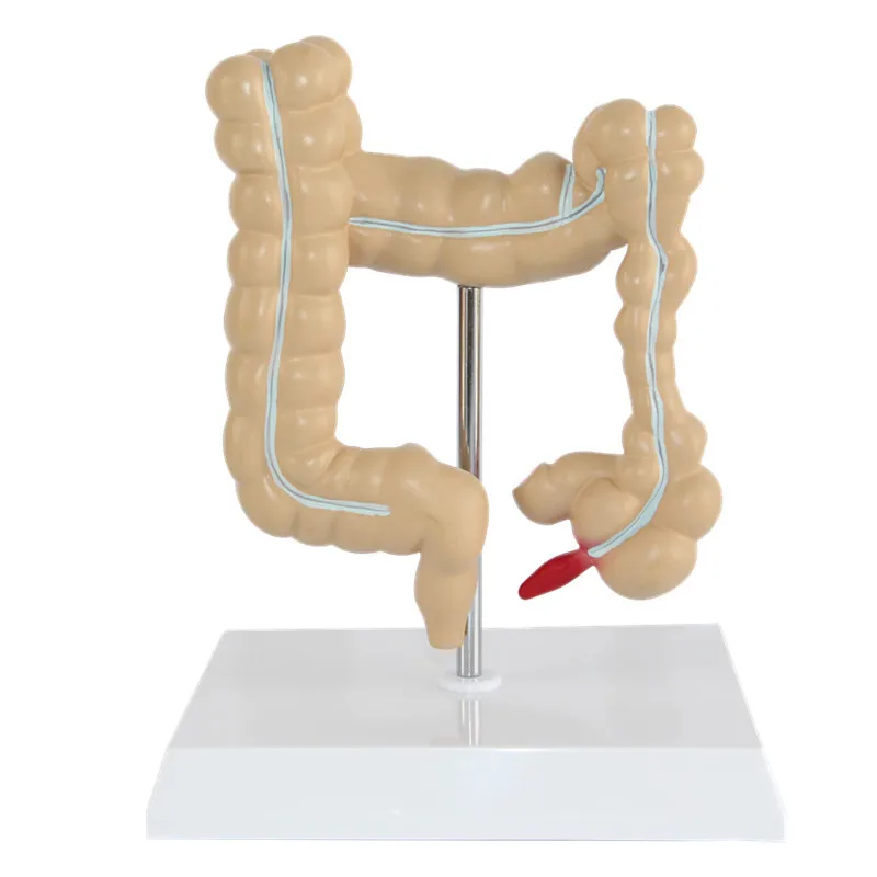 Anatomical Human Colorectal Lesion Model Anatomy Colon Diseases Intestine Medical Teaching Learning Supplies Tool - Image 5