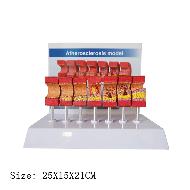Arterial Vessel Atherosclerosis Model Middle-Aged And Elderly Blood Vessel Structure Model - Image 2