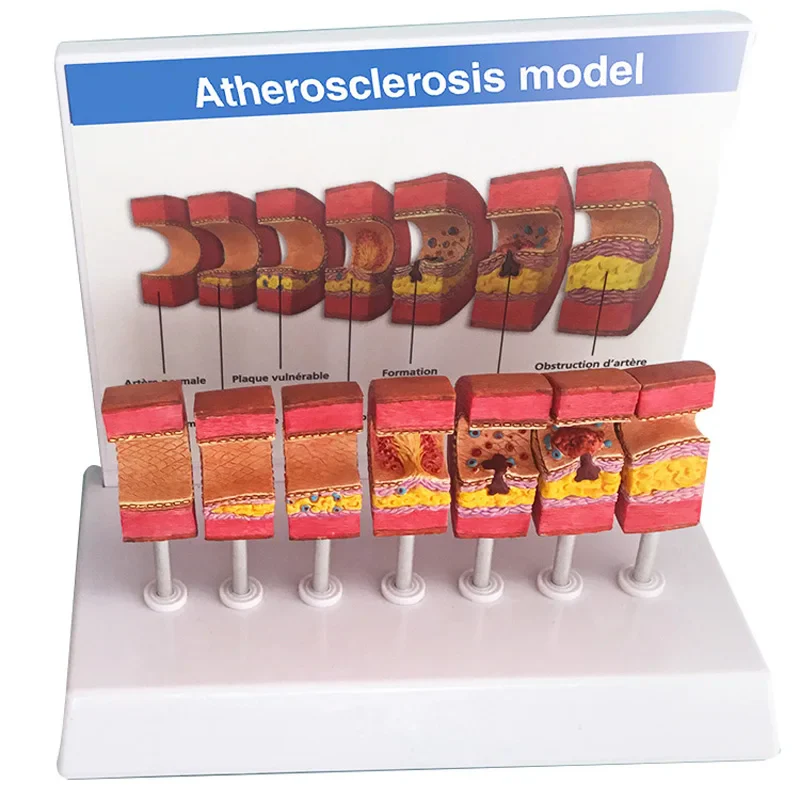 Arterial Vessel Atherosclerosis Model Middle-Aged And Elderly Blood Vessel Structure Model - Image 3