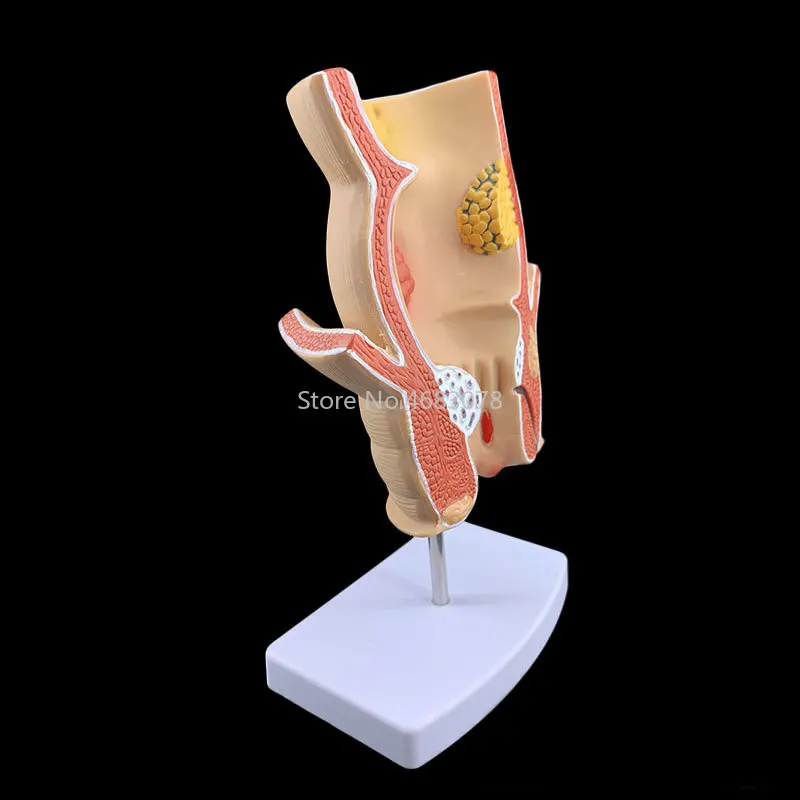 Brand New Anatomical Human Rectum Pathology Lesion Model Hemorrhoids Anus Medical Teaching Supplies - Image 3