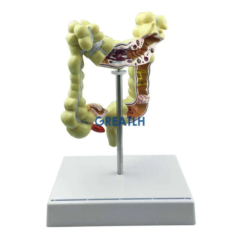 Colorectal Lesion Model Human Colon Snake Large Intestine Pathological Diseases Model Medical Organizer Anatomy - Image 2