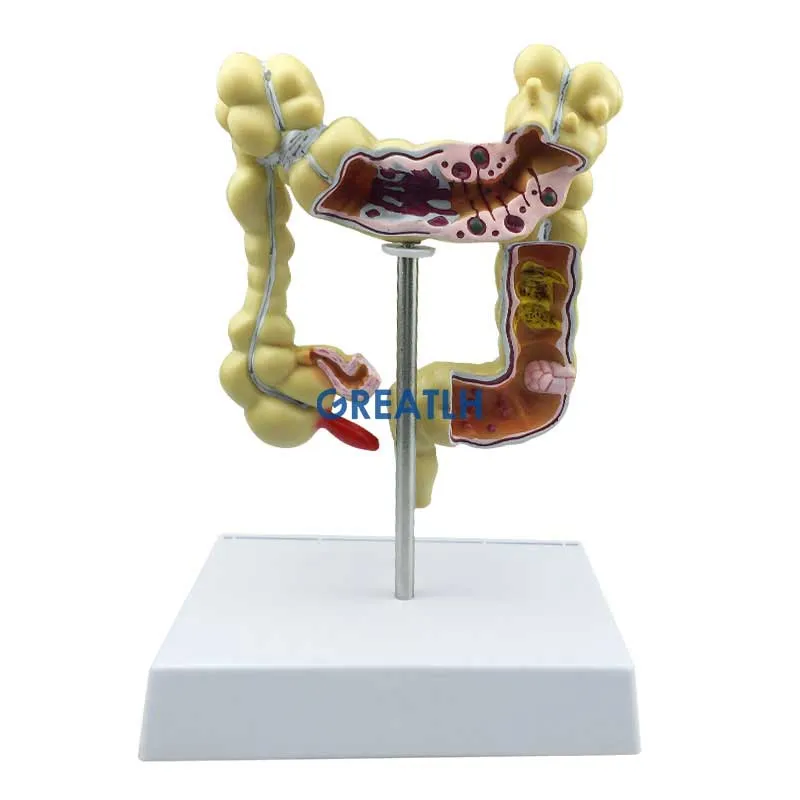 Colorectal Lesion Model Human Colon Snake Large Intestine Pathological Diseases Model Medical Organizer Anatomy - Image 3