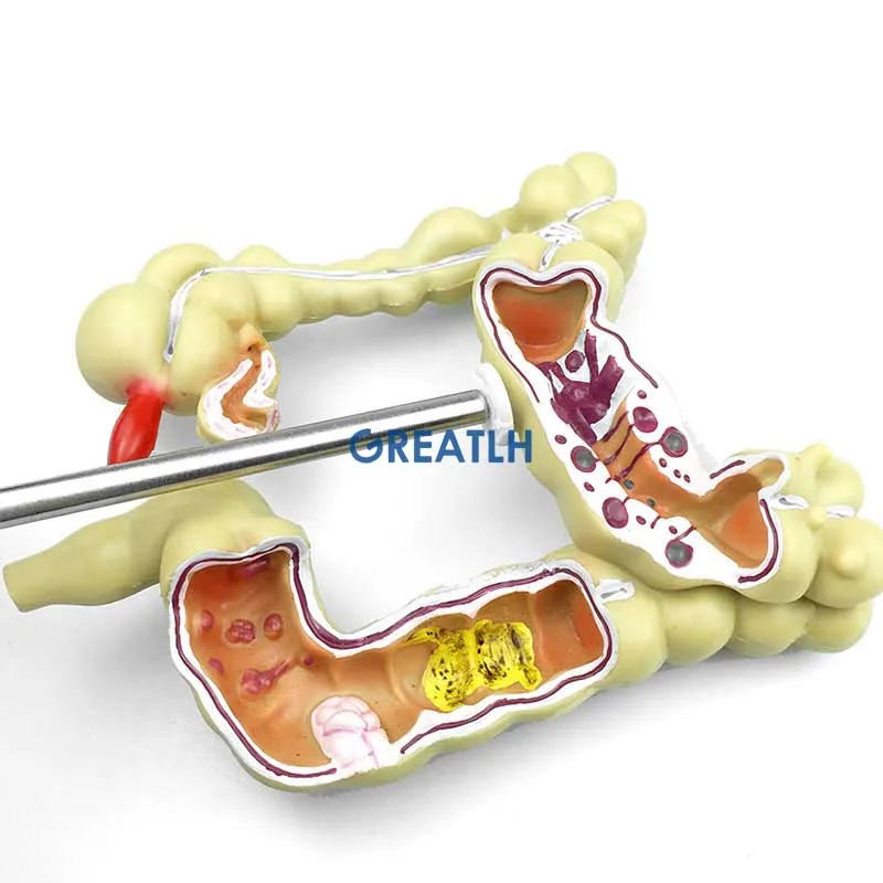 Colorectal Lesion Model Human Colon Snake Large Intestine Pathological Diseases Model Medical Organizer Anatomy - Image 4