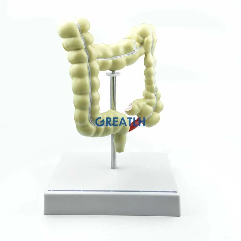 Colorectal Lesion Model Human Colon Snake Large Intestine Pathological Diseases Model Medical Organizer Anatomy - Image 5