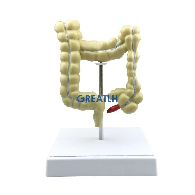 Colorectal Lesion Model Human Colon Snake Large Intestine Pathological Diseases Model Medical Organizer Anatomy - Image 6