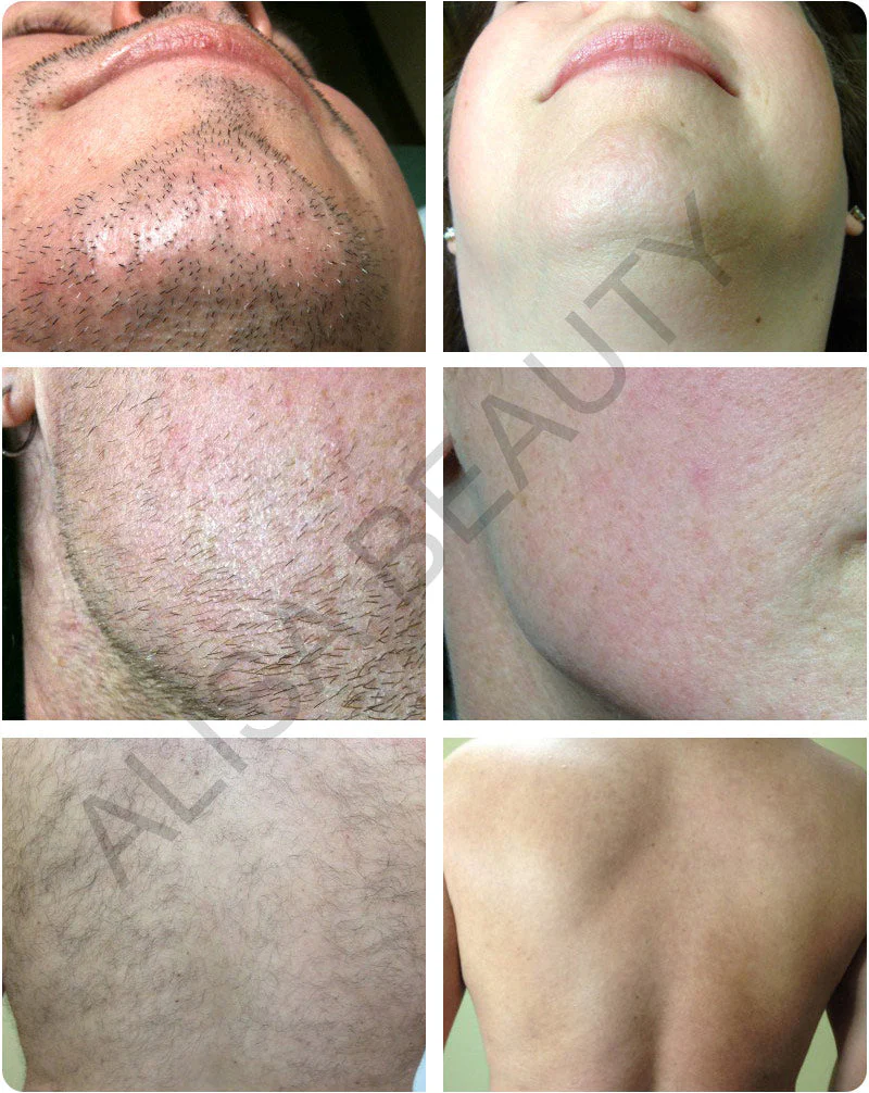 DEESS GP586 Permanent Laser Epilator IPL Hair Removal Depilatory Full Body Use Remove Acne and wrinkle Bikini Face Hair Removal - Image 12