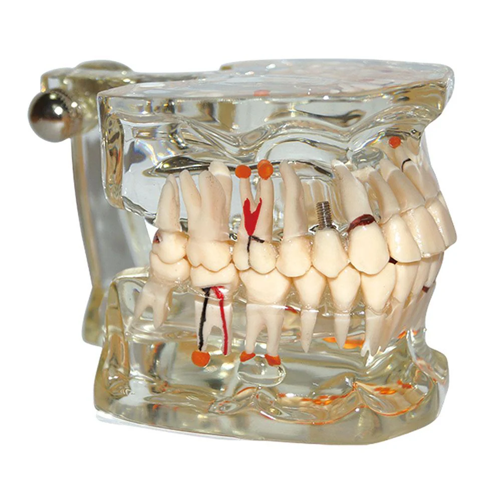Dental Model Teeth Pathology Model With Half Implant Show Clearly the Original Shape and the Whole Structure - Image 2