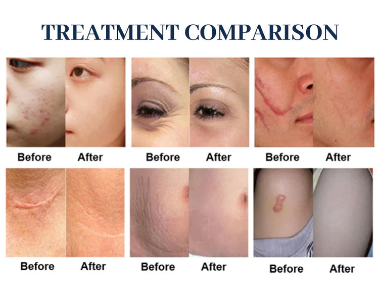 DMjet Needle-Free Injection Air Jet Beauty Machine For Acne Scar Removal Scalp Treatment - Image 10