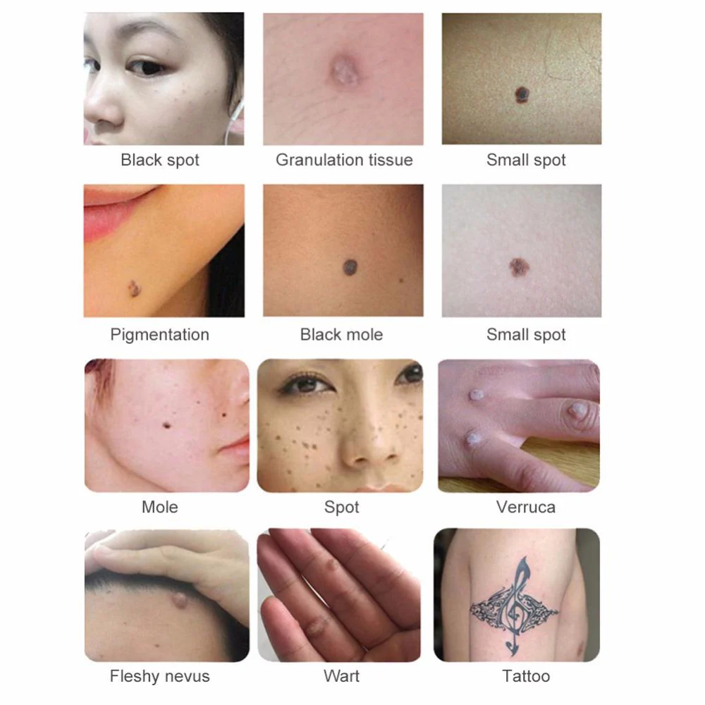 Electronic Tattoo Mole Removal Plasma Pen Laser Facial Freckle Dark Spot Remover Wart Removal Machine Face Skin Care Beauty Device - Image 4