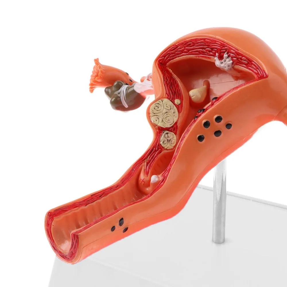 female Ovary and uterus disease Dissection model Pathology uterus model teaching human medical aids anatomy lesion uterus - Image 4