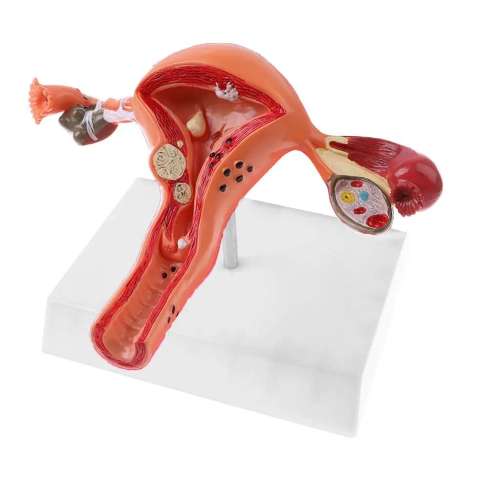 female Ovary and uterus disease Dissection model Pathology uterus model teaching human medical aids anatomy lesion uterus - Image 5