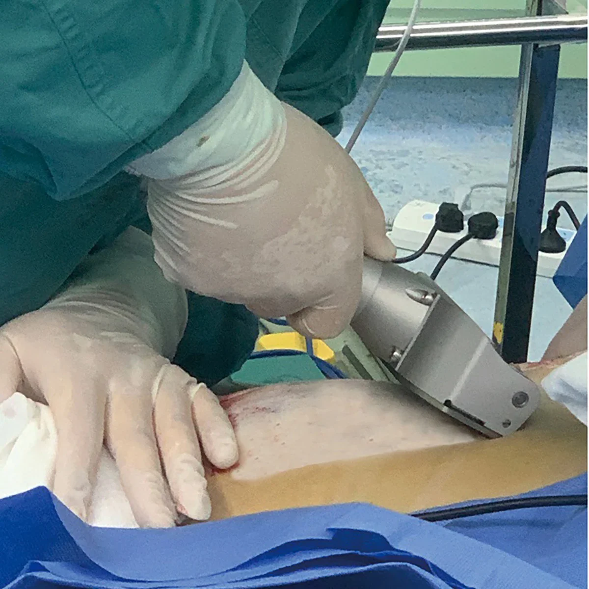 Five Skin Width Pedal Skin Grafting Electric Dermatome Blade - Image 6