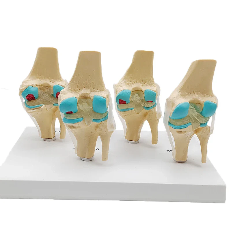 Four-stage Human Pathological Knee Joint Anatomy Model Medical Science Teaching Resources