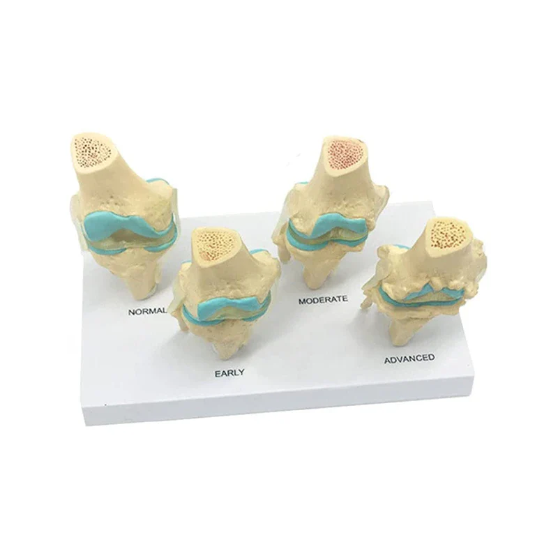 Four-stage Human Pathological Knee Joint Anatomy Model Medical Science Teaching Resources - Image 2