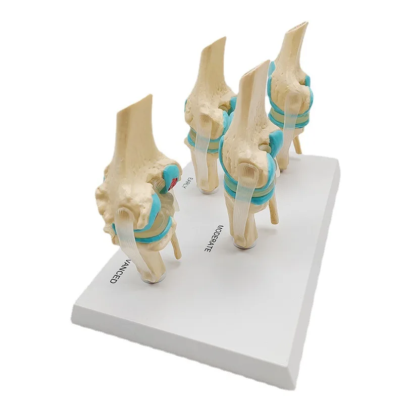 Four-stage Human Pathological Knee Joint Anatomy Model Medical Science Teaching Resources - Image 3