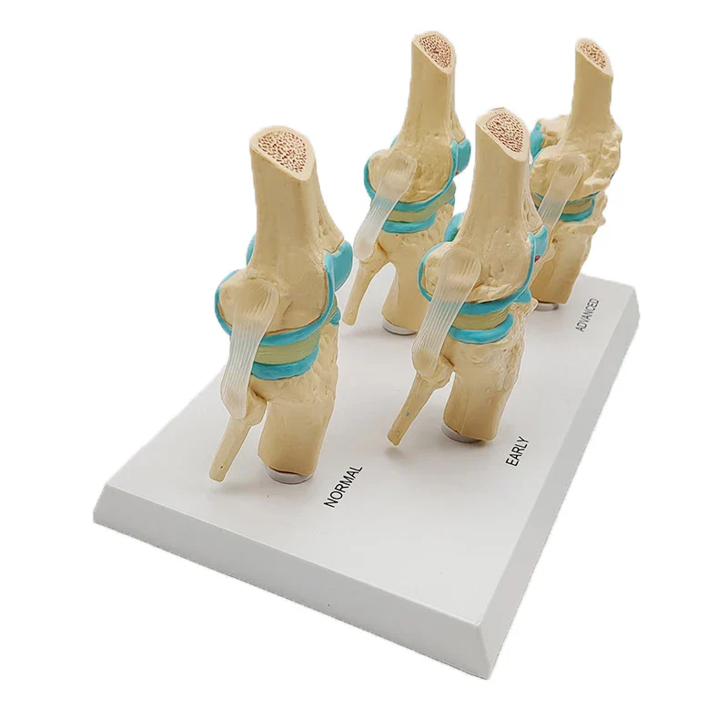 Four-stage Human Pathological Knee Joint Anatomy Model Medical Science Teaching Resources - Image 4