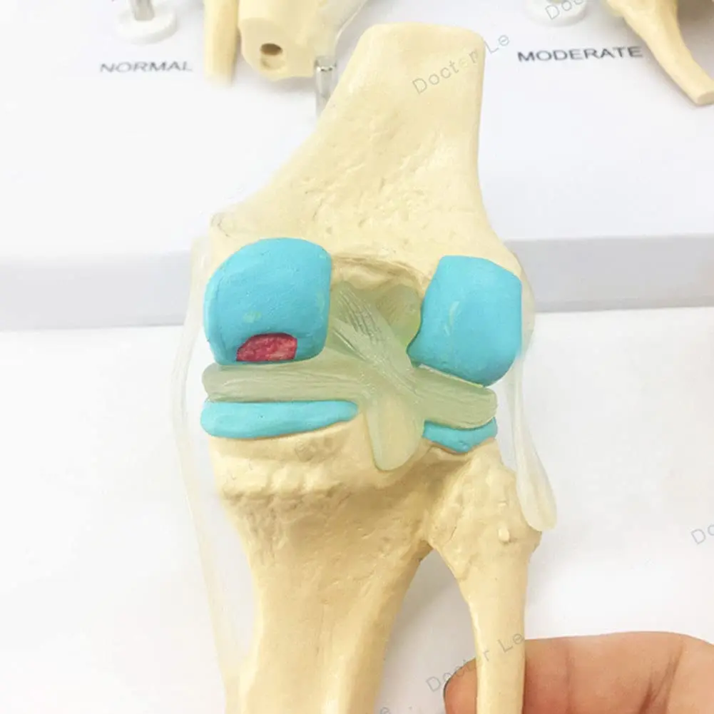 Four-stage Human Pathological Knee Joint Anatomy Model Medical Science Teaching Resources - Image 5