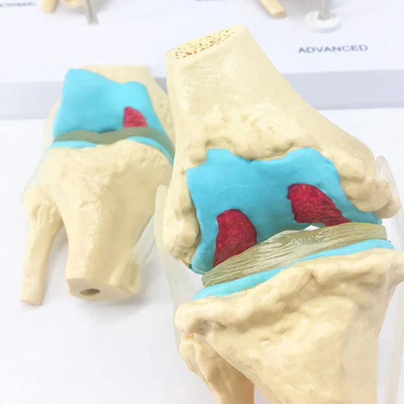 Four-stage Human Pathological Knee Joint Anatomy Model Medical Science Teaching Resources - Image 6