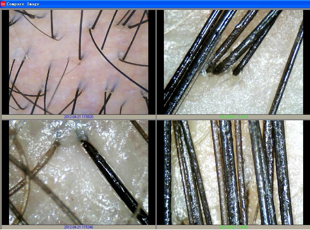 Hair Follicle Detection Hair Analyzer With Member Management Storage - Image 6