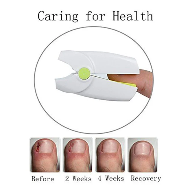 Highly Effective Rechargeable Nail Fungus Laser Device Nail Infection Onychomycosis Cure Nail Fungal Infections - Image 6