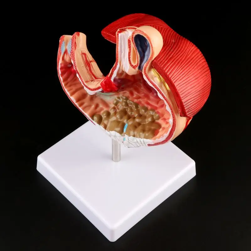 Human Anatomical Anatomy Stomach Medical Model Gastric Pathology Gastritis Ulcer Medical Teaching Learning Tool - Image 6