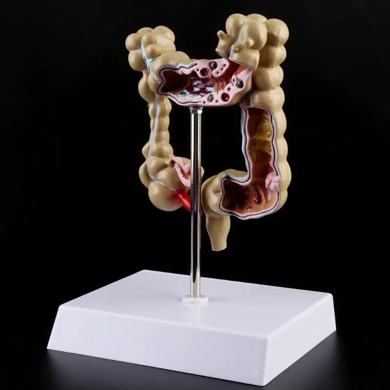 Human Colorectal Lesion Model Pathological Anatomy Colon Diseases Intestine Medical Teaching Learning Tool - Image 2