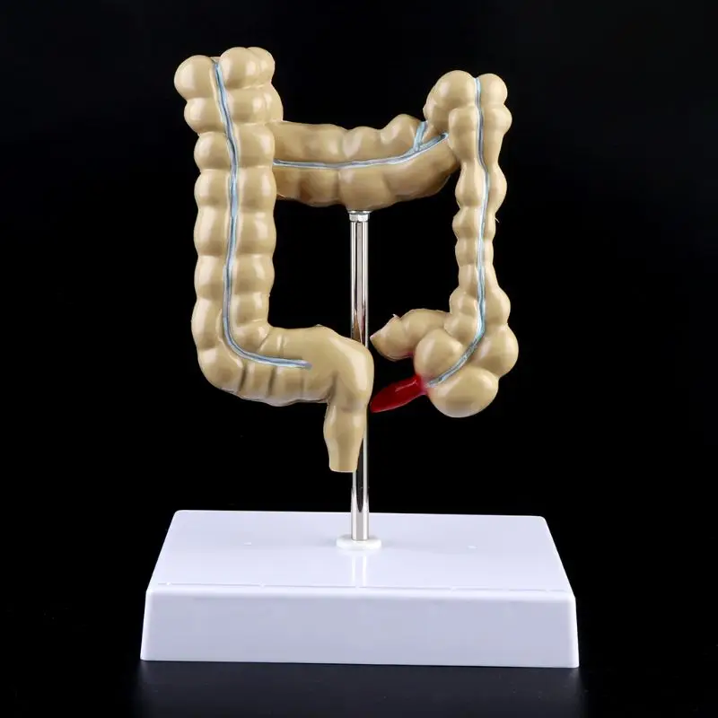 Human Colorectal Lesion Model Pathological Anatomy Colon Diseases Intestine Medical Teaching Learning Tool - Image 3