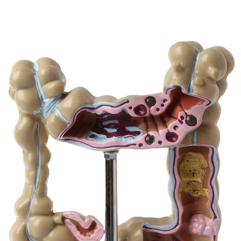 Human Colorectal Lesion Model Pathological Anatomy Colon Diseases Intestine Medical Teaching Learning Tool - Image 4