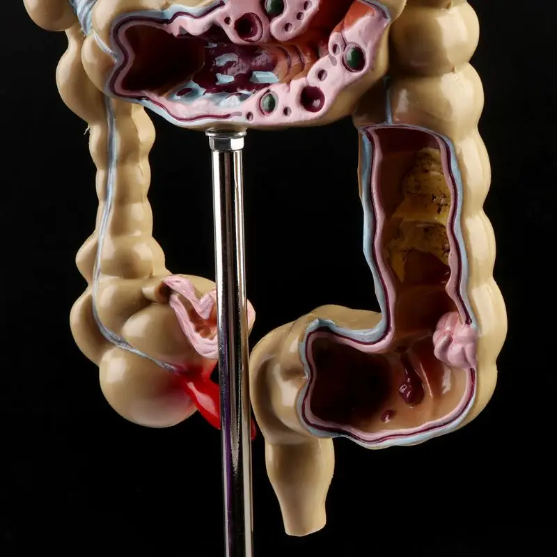 Human Colorectal Lesion Model Pathological Anatomy Colon Diseases Intestine Medical Teaching Learning Tool - Image 5