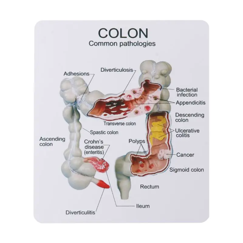 Human Colorectal Lesion Model Pathological Anatomy Colon Diseases Intestine Medical Teaching Learning Tool - Image 6