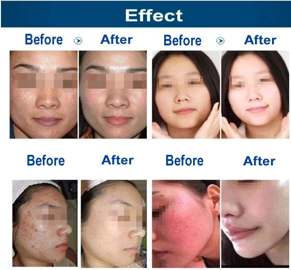 Ice Blue Hydro Machine 7 In 1 Skin Analysis Skin Care Device for Facial Cleansing Deep Pore Vacuum Hydra Skin Lift Anti-aging - Image 6