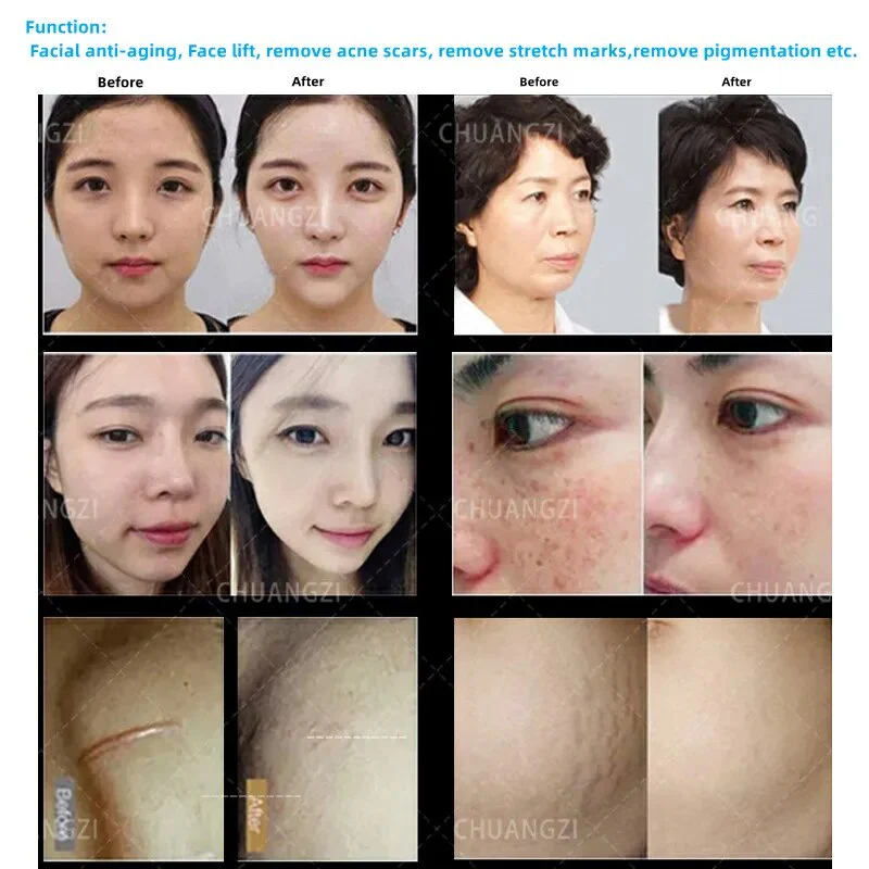 Ice Hammer Fractional RF Microneedling Machine Stretch Mark Removal Beauty Equipment Tighten Micro Needle Skin Machine - Image 4