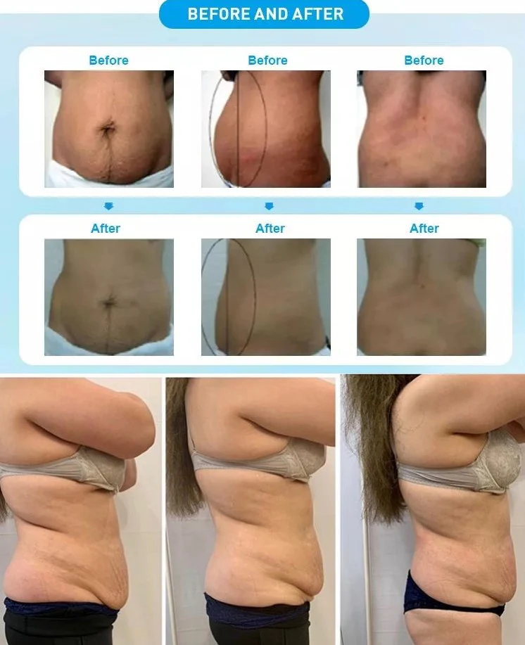 INDIBA Deep Care Beauty Body Slimming Machine Face Lift Devices Skin R45 System RF High Frequency 448KHZ Weight Loss - Image 10