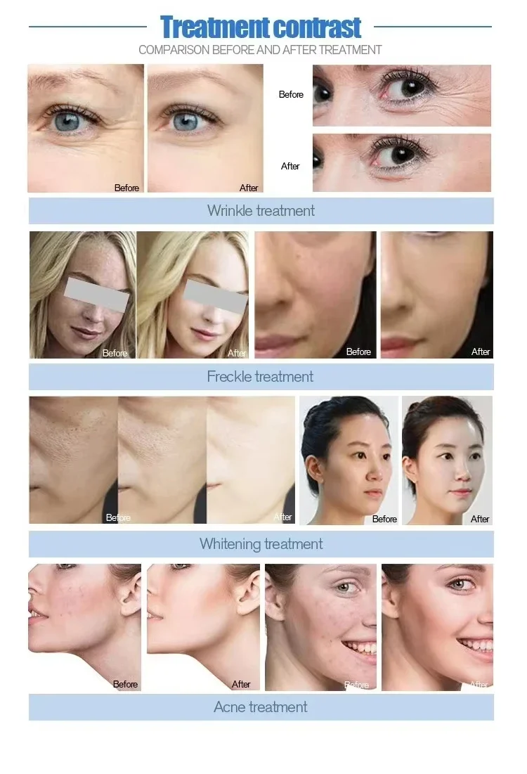 Jet Peel Moisturizing Spray - Non-Invasive Hydrating Facial Oxygen Jet Peel Machine - Image 6