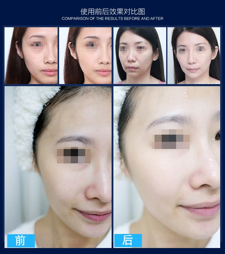 korea Vanadium Titanium Meso skin rejuvenation meso mesotherapy gun portable needle free mesotherapy machine - Image 12
