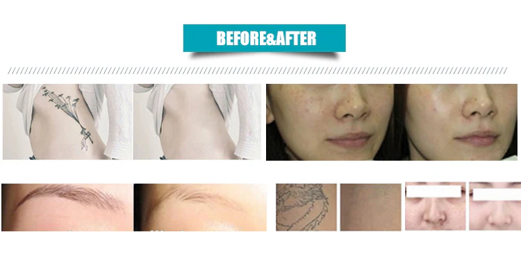 Laser Tattoo Removal System 1064nm 532nm 1320nm Q Switch ND Yag Laser Machine English language with touch screen - Image 6