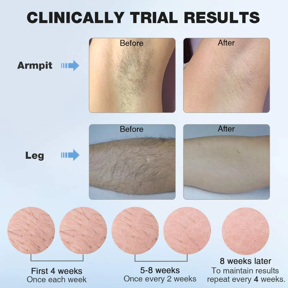 MLAY T4 Laser Hair Removal Device ICE Cold IPL Epilation 500000 Flashes IPL Painless Permanent Hair Removal - Image 6