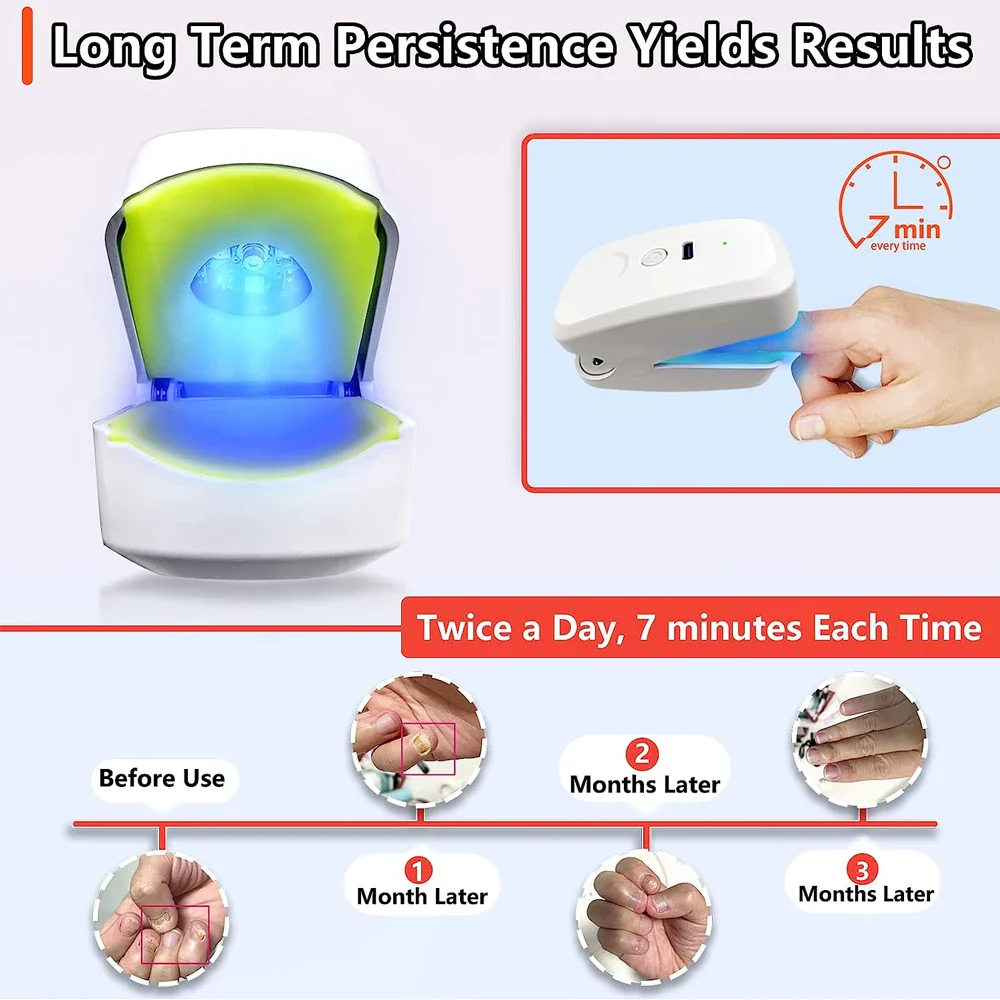 Nail Fungus Cleaning Laser Device Blue Light Nail Therapy for Damaged Discolored Thick Toenails Nail Fungus Treatments Machine - Image 4